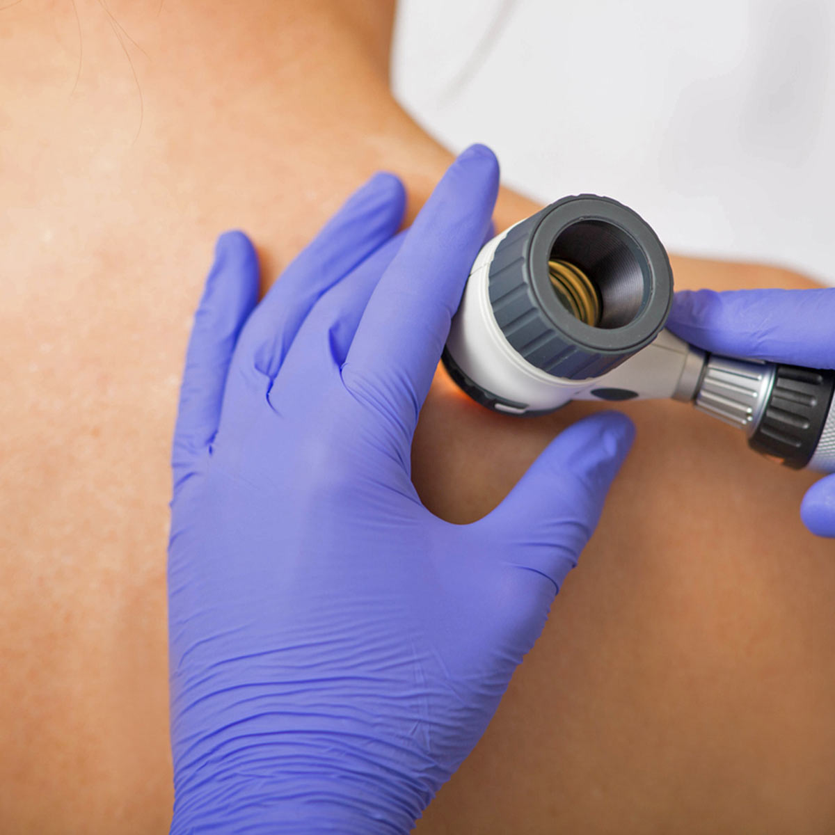 Closeup of a person's bare back while a doctors uses a scope to examine one area more closely.