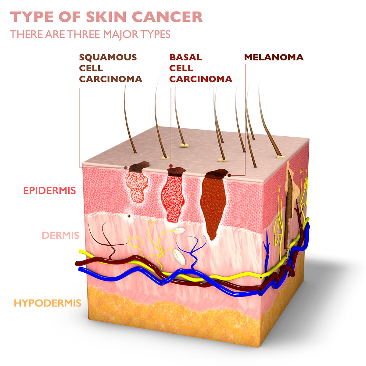 An illustration of a cross section of human skin, showing three types of skin cancer and how deeply they penetrate into the layers of skin.