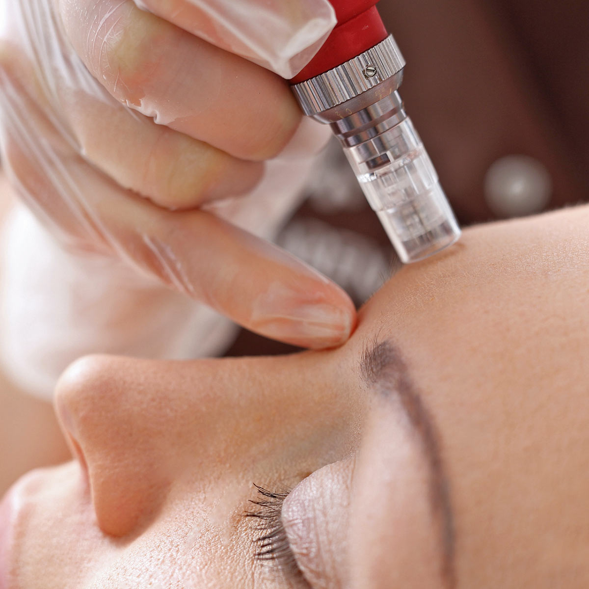 Closeup of a woman's forehead as a technician applies a microneedling treatment.