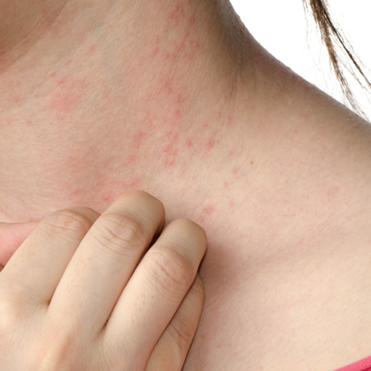 Closeup of a young woman's neck with a rash, which she is scratching.