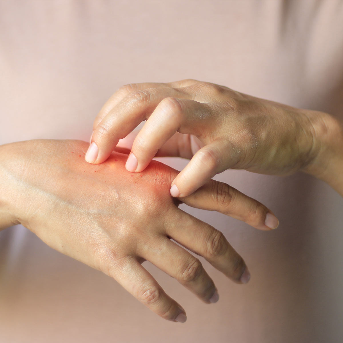 Closeup of a woman's hands, one scratching the other in apparent discomfort.
