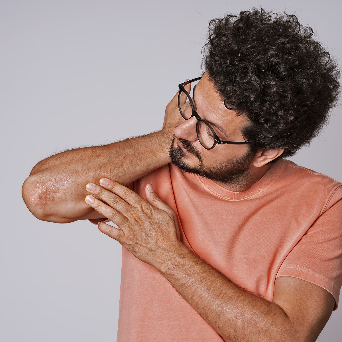A young man with glasses and curly hair examines a patch of psoriasis on his elbow.