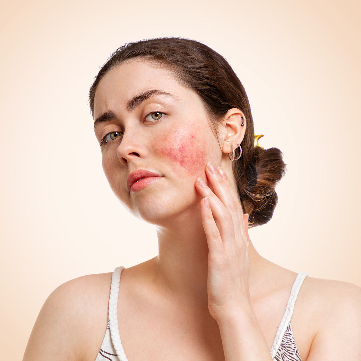 A young White woman in a tank top touches a patch of rosacea on her cheek.
