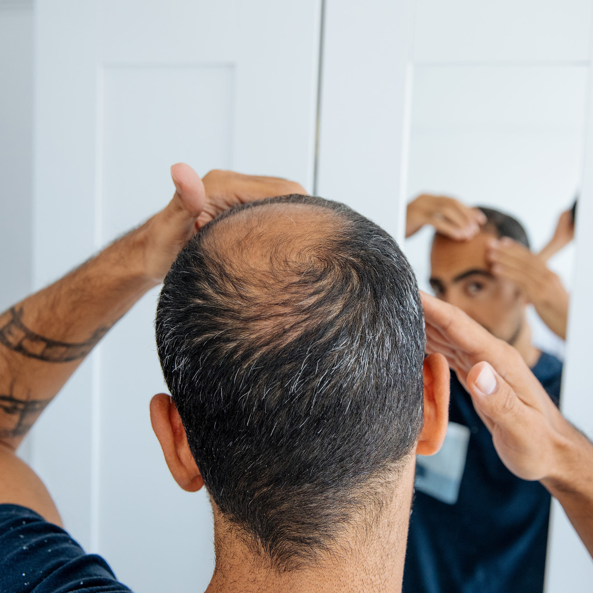 A balding younger man examines his receding hairline in a mirror.